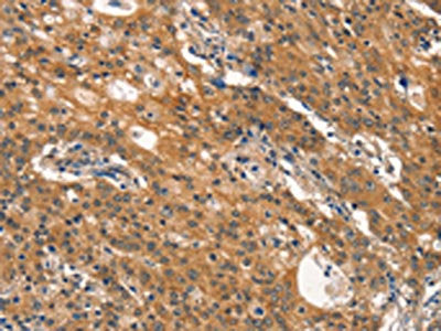 The image on the left is immunohistochemistry of paraffin-embedded Human gastic cancer tissue using CSB-PA200531(DNM2 Antibody) at dilution 1/40, on the right is treated with synthetic peptide. (Original magnification: ×200)