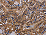 The image on the left is immunohistochemistry of paraffin-embedded Human thyroid cancer tissue using CSB-PA200543(MCTS1 Antibody) at dilution 1/60, on the right is treated with fusion protein. (Original magnification: ×200)