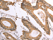 The image on the left is immunohistochemistry of paraffin-embedded Human colon cancer tissue using CSB-PA200625(NAMPT Antibody) at dilution 1/30, on the right is treated with fusion protein. (Original magnification: ×200)