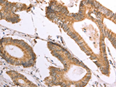 The image on the left is immunohistochemistry of paraffin-embedded Human colon cancer tissue using CSB-PA200625(NAMPT Antibody) at dilution 1/30, on the right is treated with fusion protein. (Original magnification: ×200)