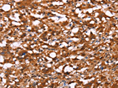 The image on the left is immunohistochemistry of paraffin-embedded Human thyroid cancer tissue using CSB-PA200670(BRK1 Antibody) at dilution 1/40, on the right is treated with synthetic peptide. (Original magnification: ×200)