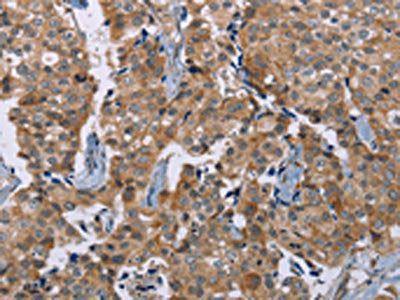 The image on the left is immunohistochemistry of paraffin-embedded Human breast cancer tissue using CSB-PA200702(PLXNA4 Antibody) at dilution 1/50, on the right is treated with synthetic peptide. (Original magnification: ×200)