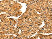 The image on the left is immunohistochemistry of paraffin-embedded Human liver cancer tissue using CSB-PA200714(S100A14 Antibody) at dilution 1/30, on the right is treated with fusion protein. (Original magnification: ×200)