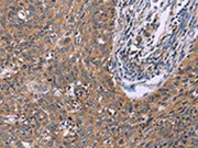 The image on the left is immunohistochemistry of paraffin-embedded Human cervical cancer tissue using CSB-PA200894(CSF2RB Antibody) at dilution 1/40, on the right is treated with synthetic peptide. (Original magnification: ×200)