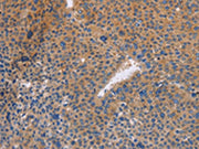 The image on the left is immunohistochemistry of paraffin-embedded Human liver cancer tissue using CSB-PA200941(NEK8 Antibody) at dilution 1/30, on the right is treated with fusion protein. (Original magnification: ×200)