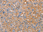 The image on the left is immunohistochemistry of paraffin-embedded Human liver cancer tissue using CSB-PA201250(PAGE5 Antibody) at dilution 1/55, on the right is treated with fusion protein. (Original magnification: ×200)