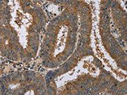 The image on the left is immunohistochemistry of paraffin-embedded Human colon cancer tissue using CSB-PA201270(DNAJA1 Antibody) at dilution 1/60, on the right is treated with fusion protein. (Original magnification: ×200)