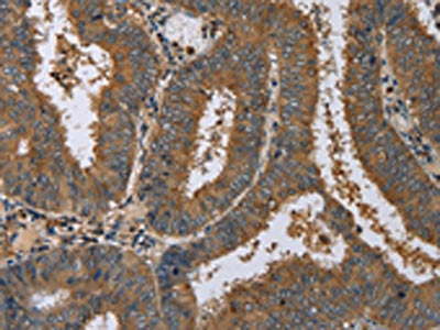 The image on the left is immunohistochemistry of paraffin-embedded Human colon cancer tissue using CSB-PA201270(DNAJA1 Antibody) at dilution 1/60, on the right is treated with fusion protein. (Original magnification: ×200)