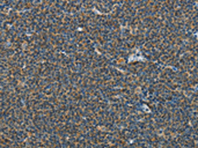 The image on the left is immunohistochemistry of paraffin-embedded Human lymphoma tissue using CSB-PA201420(PITX3 Antibody) at dilution 1/40, on the right is treated with synthetic peptide. (Original magnification: ×200)