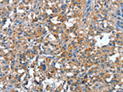 The image on the left is immunohistochemistry of paraffin-embedded Human thyroid cancer tissue using CSB-PA202119(PLA2G6 Antibody) at dilution 1/15, on the right is treated with synthetic peptide. (Original magnification: ×200)