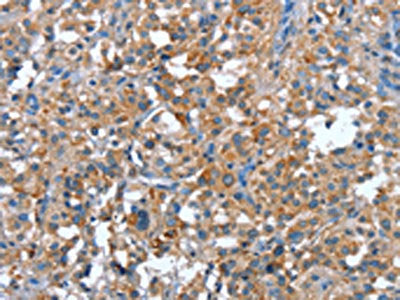 The image on the left is immunohistochemistry of paraffin-embedded Human thyroid cancer tissue using CSB-PA202119(PLA2G6 Antibody) at dilution 1/15, on the right is treated with synthetic peptide. (Original magnification: ×200)