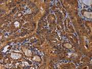 The image on the left is immunohistochemistry of paraffin-embedded Human thyroid cancer tissue using CSB-PA202304(MAGEB10 Antibody) at dilution 1/60, on the right is treated with fusion protein. (Original magnification: ×200)