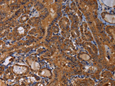 The image on the left is immunohistochemistry of paraffin-embedded Human thyroid cancer tissue using CSB-PA202304(MAGEB10 Antibody) at dilution 1/60, on the right is treated with fusion protein. (Original magnification: ×200)