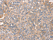 The image on the left is immunohistochemistry of paraffin-embedded Human breast cancer tissue using CSB-PA202328(PDLIM4 Antibody) at dilution 1/40, on the right is treated with fusion protein. (Original magnification: ×200)