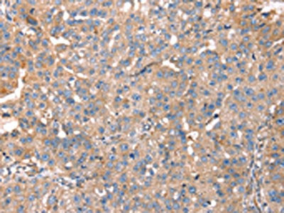 The image on the left is immunohistochemistry of paraffin-embedded Human breast cancer tissue using CSB-PA202328(PDLIM4 Antibody) at dilution 1/40, on the right is treated with fusion protein. (Original magnification: ×200)