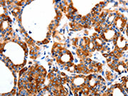 The image on the left is immunohistochemistry of paraffin-embedded Human thyroid cancer tissue using CSB-PA202569(HCN1 Antibody) at dilution 1/80, on the right is treated with synthetic peptide. (Original magnification: ×200)