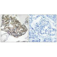 Immunohistochemistry analysis of paraffin-embedded human breast carcinoma tissue using RPS25 antibody.