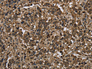 The image on the left is immunohistochemistry of paraffin-embedded Human liver cancer tissue using CSB-PA202913(KSR1 Antibody) at dilution 1/25, on the right is treated with synthetic peptide. (Original magnification: ×200)