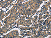 The image on the left is immunohistochemistry of paraffin-embedded Human breast cancer tissue using CSB-PA203041(SH2B2 Antibody) at dilution 1/30, on the right is treated with synthetic peptide. (Original magnification: ×200)