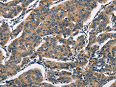 The image on the left is immunohistochemistry of paraffin-embedded Human breast cancer tissue using CSB-PA203041(SH2B2 Antibody) at dilution 1/30, on the right is treated with synthetic peptide. (Original magnification: ×200)