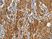 The image on the left is immunohistochemistry of paraffin-embedded Human gastic cancer tissue using CSB-PA203218(BGN Antibody) at dilution 1/50, on the right is treated with fusion protein. (Original magnification: ×200)