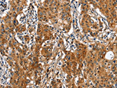 The image on the left is immunohistochemistry of paraffin-embedded Human gastic cancer tissue using CSB-PA203218(BGN Antibody) at dilution 1/50, on the right is treated with fusion protein. (Original magnification: ×200)