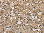 The image on the left is immunohistochemistry of paraffin-embedded Human thyroid cancer tissue using CSB-PA203277(PKD1 Antibody) at dilution 1/50, on the right is treated with synthetic peptide. (Original magnification: ×200)