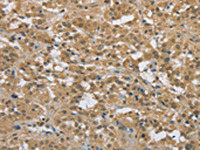 The image on the left is immunohistochemistry of paraffin-embedded Human thyroid cancer tissue using CSB-PA203277(PKD1 Antibody) at dilution 1/50, on the right is treated with synthetic peptide. (Original magnification: ×200)