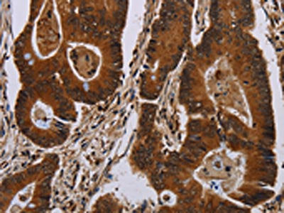 The image on the left is immunohistochemistry of paraffin-embedded Human colon cancer tissue using CSB-PA203330(DCAF6 Antibody) at dilution 1/50, on the right is treated with synthetic peptide. (Original magnification: ×200)