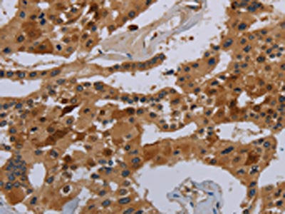 The image on the left is immunohistochemistry of paraffin-embedded Human prostate cancer tissue using CSB-PA203427(COX18 Antibody) at dilution 1/20, on the right is treated with synthetic peptide. (Original magnification: ×200)
