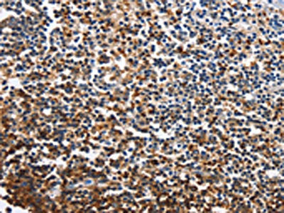 The image on the left is immunohistochemistry of paraffin-embedded Human tonsil tissue using CSB-PA203536(CDO1 Antibody) at dilution 1/40, on the right is treated with fusion protein. (Original magnification: ×200)