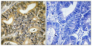 Immunohistochemical analysis of paraffin-embedded human colon carcinoma tissue using 4E-BP1 (Phospho-Thr70) antibody (left)or the same antibody preincubated with blocking peptide (right).