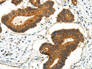 The image on the left is immunohistochemistry of paraffin-embedded Human colorectal cancer tissue using CSB-PA203676(AQP3 Antibody) at dilution 1/35, on the right is treated with synthetic peptide. (Original magnification: ×200)