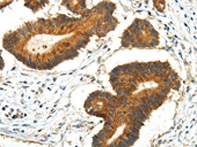 The image on the left is immunohistochemistry of paraffin-embedded Human colorectal cancer tissue using CSB-PA203676(AQP3 Antibody) at dilution 1/35, on the right is treated with synthetic peptide. (Original magnification: ×200)