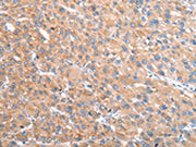 The image on the left is immunohistochemistry of paraffin-embedded Human liver cancer tissue using CSB-PA203811(VPS16 Antibody) at dilution 1/35, on the right is treated with fusion protein. (Original magnification: ×200)