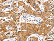 The image on the left is immunohistochemistry of paraffin-embedded Human lung cancer tissue using CSB-PA203867(NUAK1 Antibody) at dilution 1/70, on the right is treated with synthetic peptide. (Original magnification: ×200)
