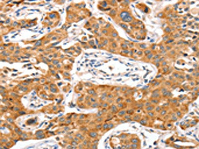 The image on the left is immunohistochemistry of paraffin-embedded Human lung cancer tissue using CSB-PA203867(NUAK1 Antibody) at dilution 1/70, on the right is treated with synthetic peptide. (Original magnification: ×200)