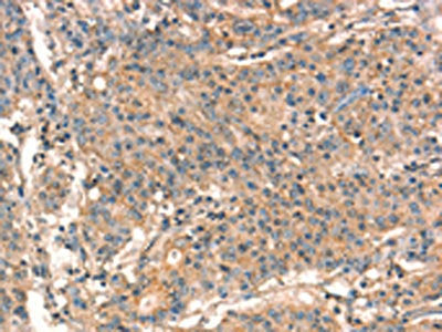 The image on the left is immunohistochemistry of paraffin-embedded Human gastic cancer tissue using CSB-PA204025(STK17A Antibody) at dilution 1/15, on the right is treated with synthetic peptide. (Original magnification: ×200)
