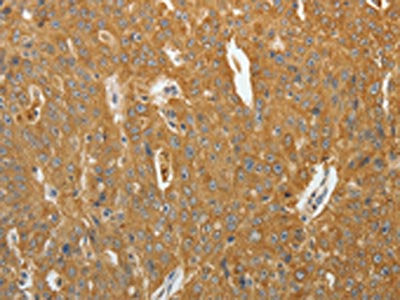 The image on the left is immunohistochemistry of paraffin-embedded Human ovarian cancer tissue using CSB-PA204064(AKR1B1 Antibody) at dilution 1/40, on the right is treated with synthetic peptide. (Original magnification: ×200)