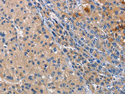 The image on the left is immunohistochemistry of paraffin-embedded Human liver cancer tissue using CSB-PA204342(CD207 Antibody) at dilution 1/40, on the right is treated with fusion protein. (Original magnification: x200)