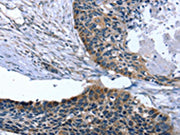 The image on the left is immunohistochemistry of paraffin-embedded Human esophagus cancer tissue using CSB-PA204496(ARMC10 Antibody) at dilution 1/30, on the right is treated with fusion protein. (Original magnification: ×200)