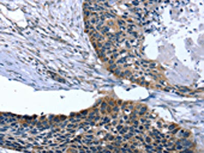 The image on the left is immunohistochemistry of paraffin-embedded Human esophagus cancer tissue using CSB-PA204496(ARMC10 Antibody) at dilution 1/30, on the right is treated with fusion protein. (Original magnification: ×200)
