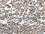 The image on the left is immunohistochemistry of paraffin-embedded Human tonsil tissue using CSB-PA204522(INHA Antibody) at dilution 1/120, on the right is treated with fusion protein. (Original magnification: ×200)