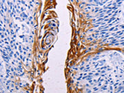 The image on the left is immunohistochemistry of paraffin-embedded Human esophagus cancer tissue using CSB-PA204706(FGF7 Antibody) at dilution 1/15, on the right is treated with synthetic peptide. (Original magnification: ×200)