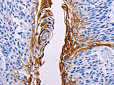 The image on the left is immunohistochemistry of paraffin-embedded Human esophagus cancer tissue using CSB-PA204706(FGF7 Antibody) at dilution 1/15, on the right is treated with synthetic peptide. (Original magnification: ×200)