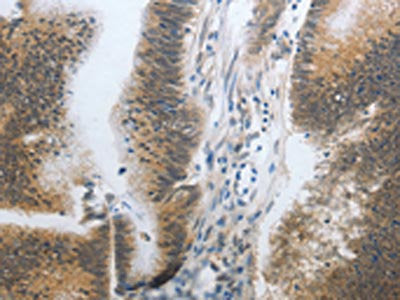 The image on the left is immunohistochemistry of paraffin-embedded Human colon cancer tissue using CSB-PA205008(CST3 Antibody) at dilution 1/20, on the right is treated with synthetic peptide. (Original magnification: ×200)