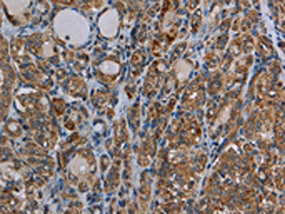The image on the left is immunohistochemistry of paraffin-embedded Human thyroid cancer tissue using CSB-PA205085(MYO7A Antibody) at dilution 1/30, on the right is treated with synthetic peptide. (Original magnification: ×200)