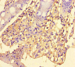 Immunohistochemistry of paraffin-embedded human colon cancer using CSB-PA20519A0Rb at dilution of 1:100