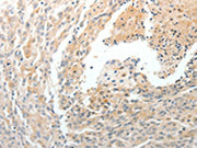 The image on the left is immunohistochemistry of paraffin-embedded Human cervical cancer tissue using CSB-PA205301(CD93 Antibody) at dilution 1/50, on the right is treated with synthetic peptide. (Original magnification: ×200)