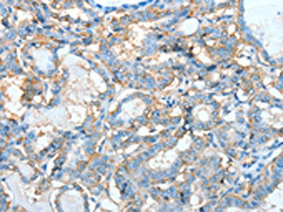 The image on the left is immunohistochemistry of paraffin-embedded Human thyroid cancer tissue using CSB-PA205525(AGBL3 Antibody) at dilution 1/45, on the right is treated with fusion protein. (Original magnification: ×200)